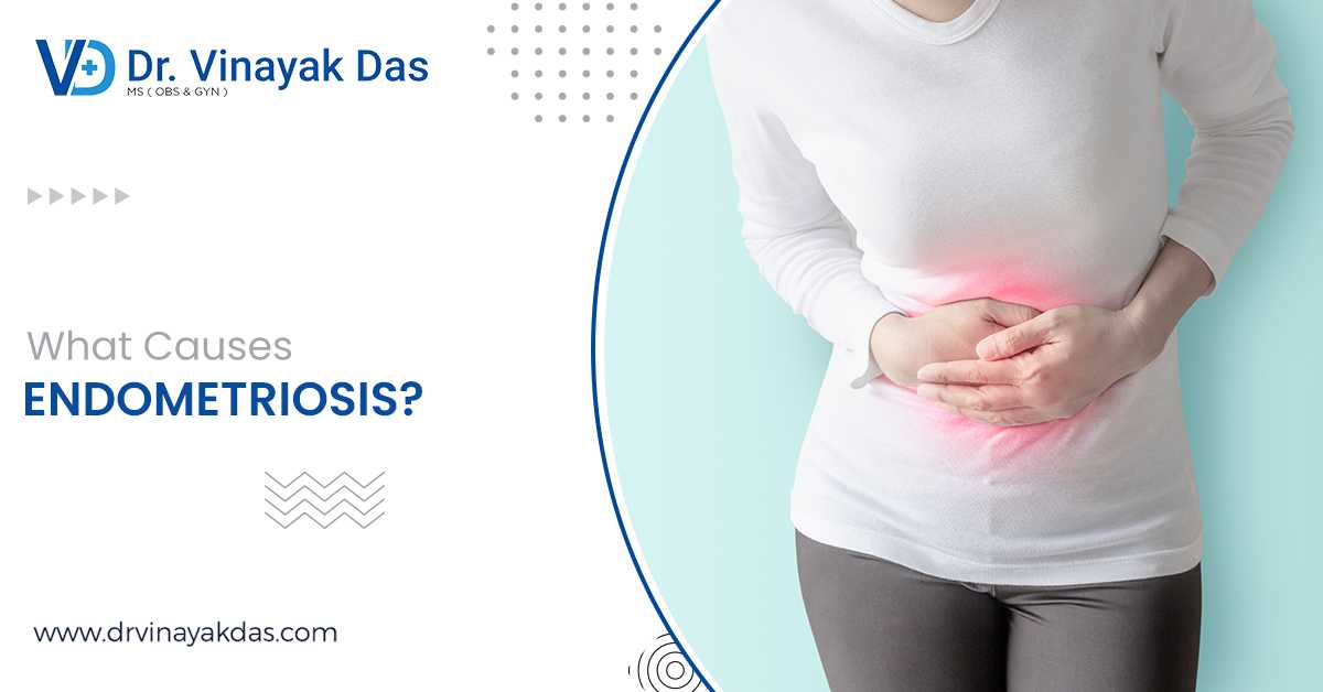 What Causes Endometriosis?