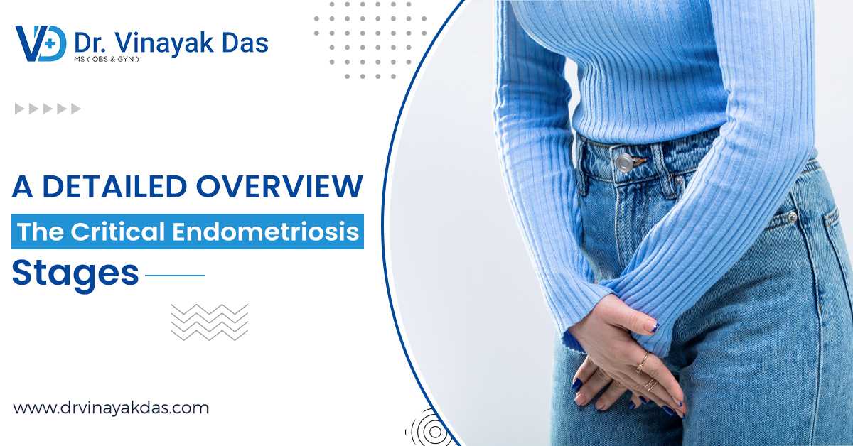 A Detailed Overview Of The Critical Endometriosis Stages