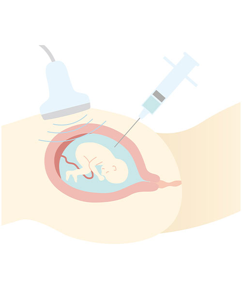 Amniocentesis