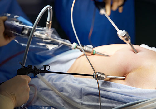 Laparoscopic Gynaecological Procedures