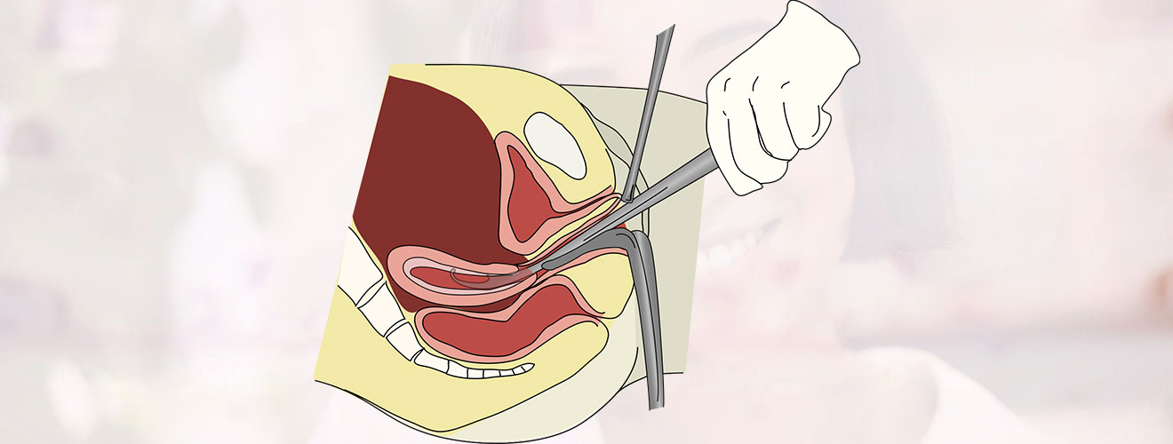 Dilation and Curettage (D&C)