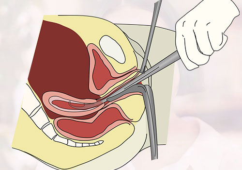 Dilation and Curettage (D&C)