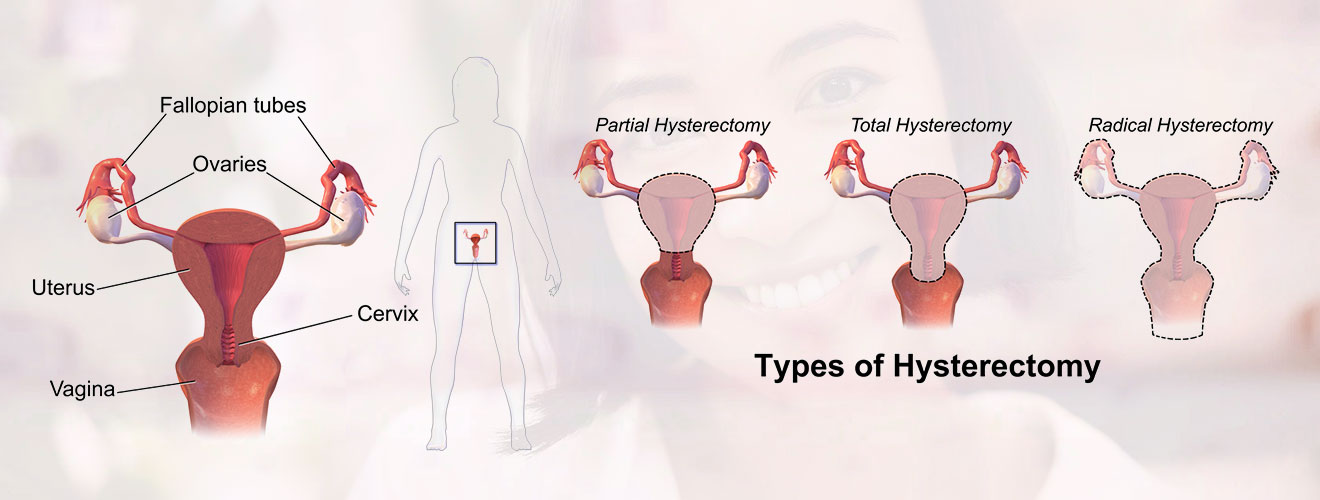 Hysterectomy (Abdominal / Vaginal / Laparoscopic / Robotic)
