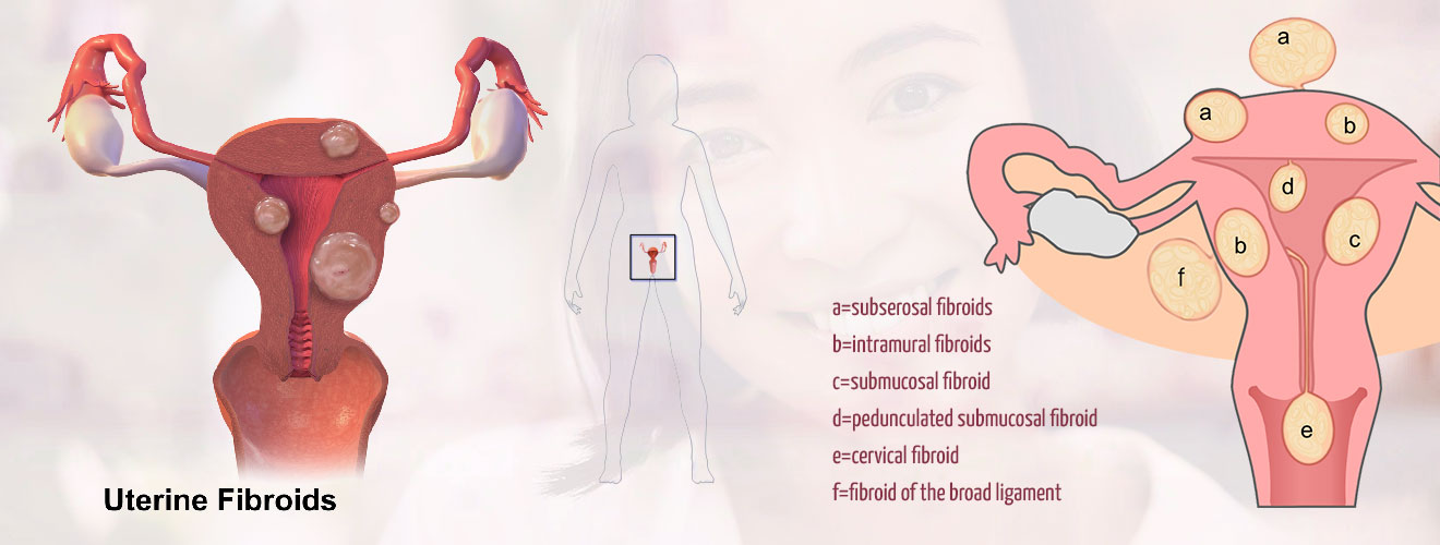 Myomectomy (Open or Laparoscopic)