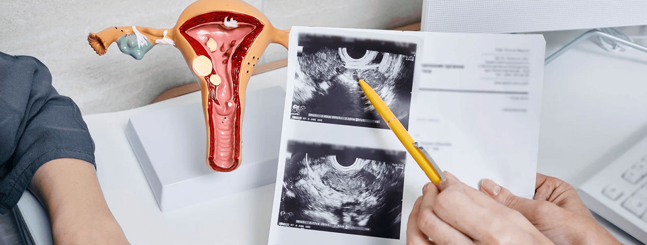 Salpingo-Oophorectomy