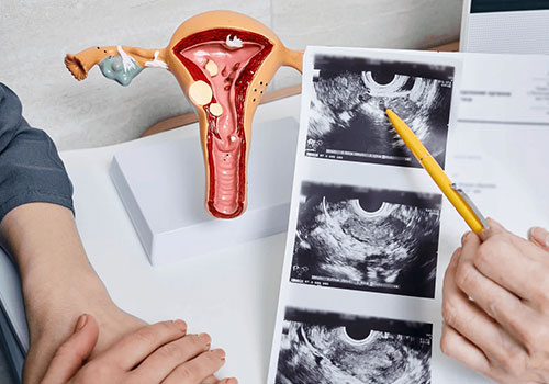 Salpingo-Oophorectomy