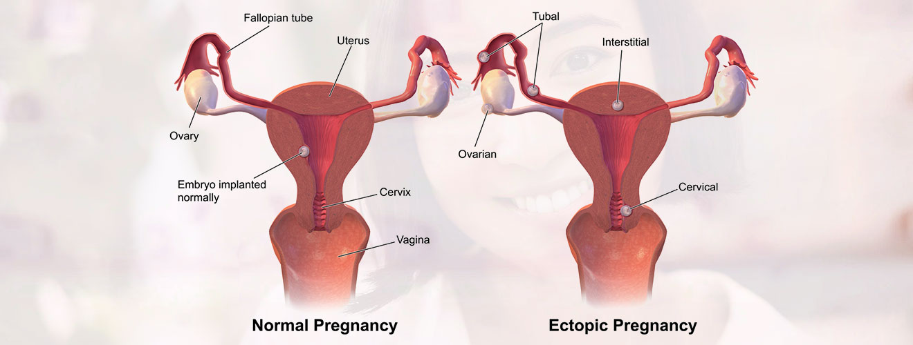 Ectopic Pregnancy Surgery
