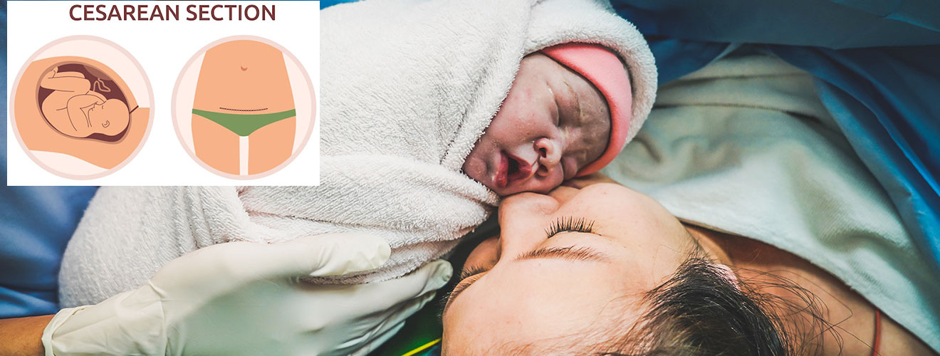 Cesarean Section (C-section)