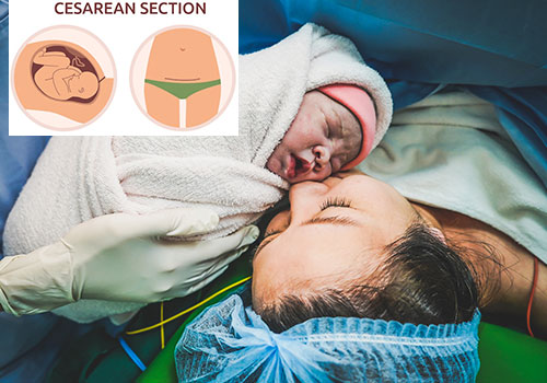 Cesarean Section (C-section)
