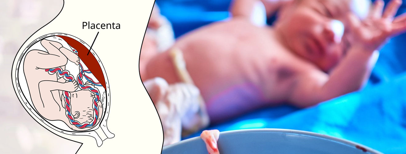 Manual Removal of Placenta