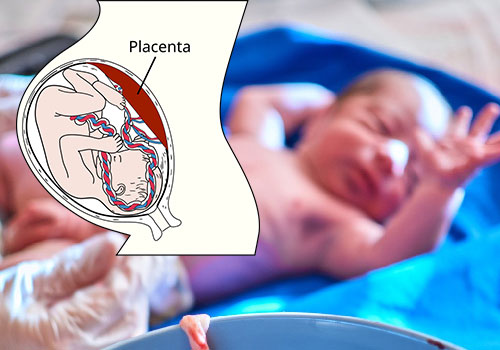 Manual Removal of Placenta