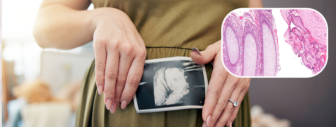 Evacuation of Retained Products of Conception (ERPC)