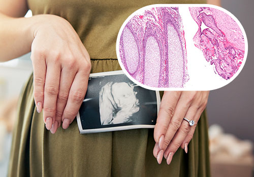 Evacuation of Retained Products of Conception (ERPC)