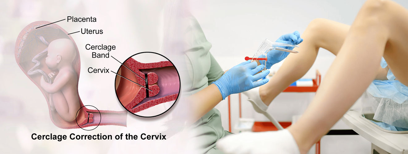 Cervical Stitch Procedure