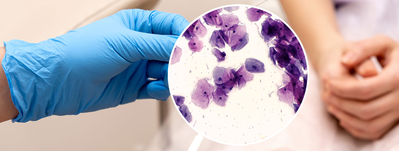 Pap Smear (Cervical Cytology)