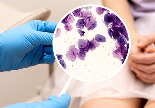 Pap Smear (Cervical Cytology)