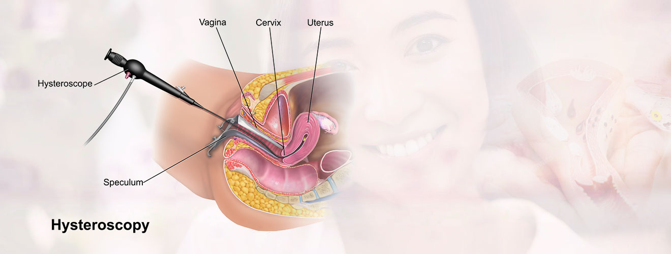 Hysteroscopy