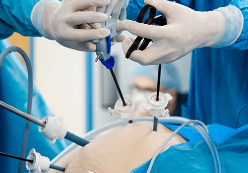 Laparoscopic Hysterectomy