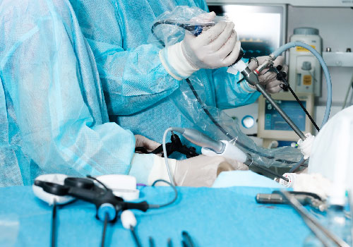 Laparoscopic Salpingectomy