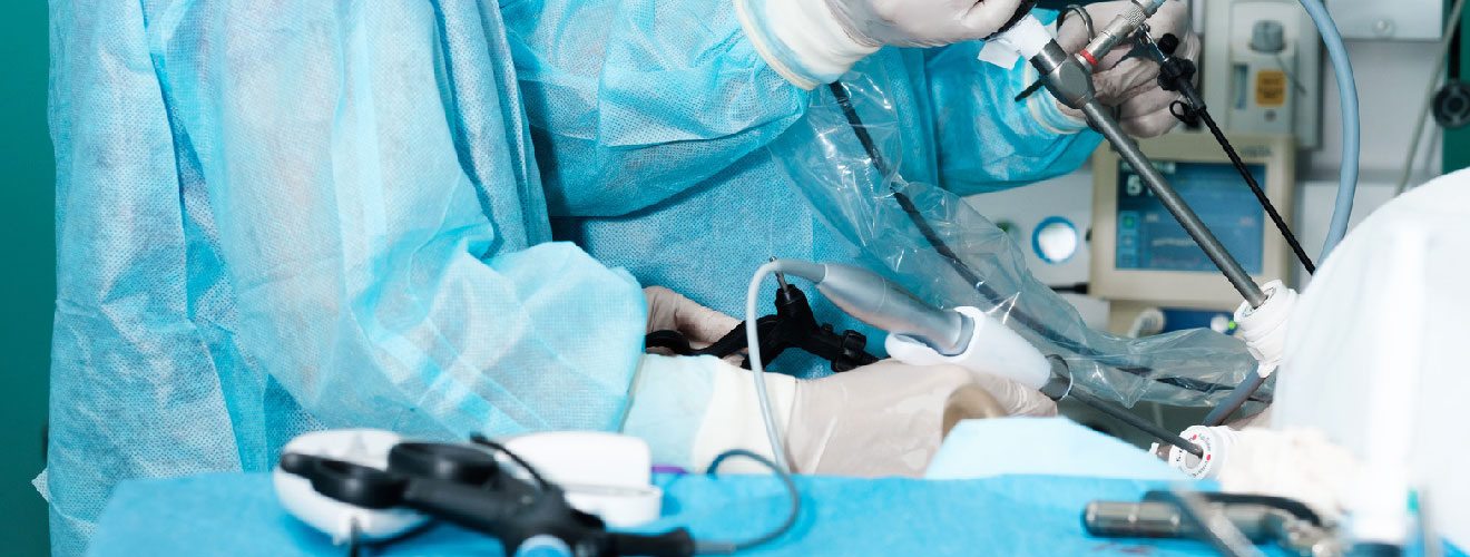 Laparoscopic Salpingectomy