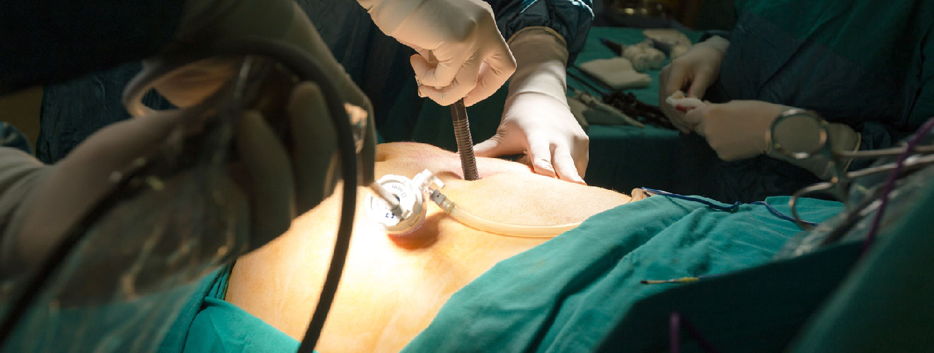 Laparoscopic Endometriosis Excision or Ablation