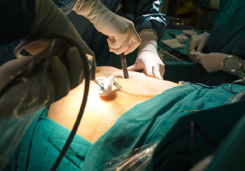 Laparoscopic Endometriosis Excision or Ablation